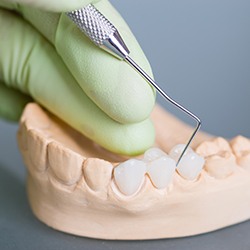Model of teeth with fixed bridge