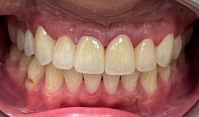Bright white smile after teeth whitening