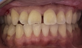 Yellow and discolored smile before teeth whitening