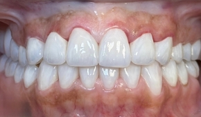 Bright white smile after teeth whitening
