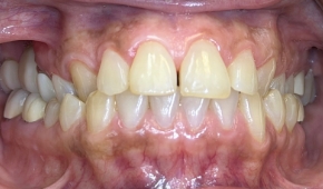 Yellow and discolored smile before teeth whitening