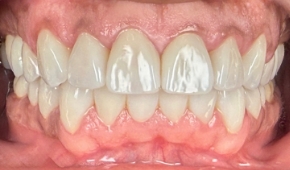 Bright white smile after teeth whitening