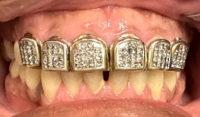 Yellow and discolored smile before teeth whitening