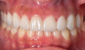 Bright white smile after teeth whitening