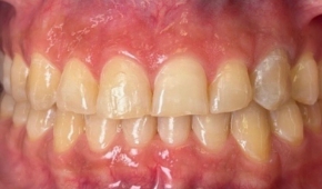 Yellow and discolored smile before teeth whitening