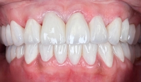 Bright white smile after teeth whitening