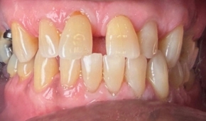 Yellow and discolored smile before teeth whitening