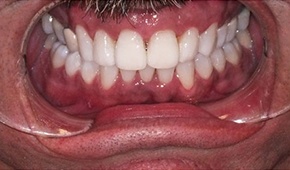 Gorgeous smile following teeth whitening