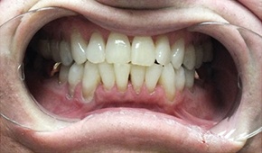 Flawless smile following professional teeth whitening