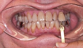 Discolored teeth closeup before whitening
