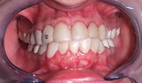 Discolored and decayed teeth and damaged gums