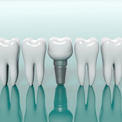 dental implant