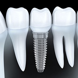 Animation of implant supported crown