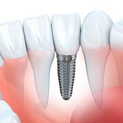 Model of implant supported dentures