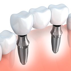 Model of implant supported dental crown