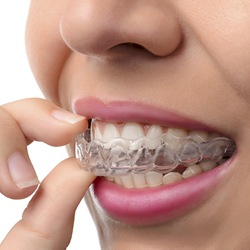 Woman inserting Invisalign