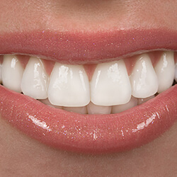 A smile after a full mouth reconstruction in Pearland, TX.