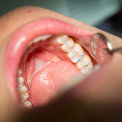 Bite examined after filling placement