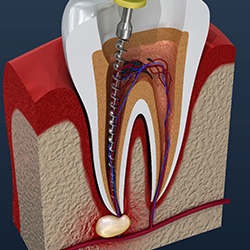 root canal procedure