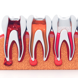 Model showing steps in procedure for root canal