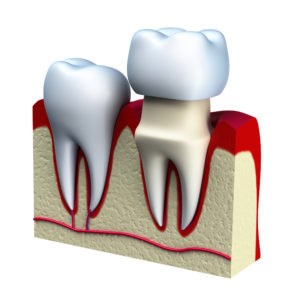 3D Model of a Dental Crown