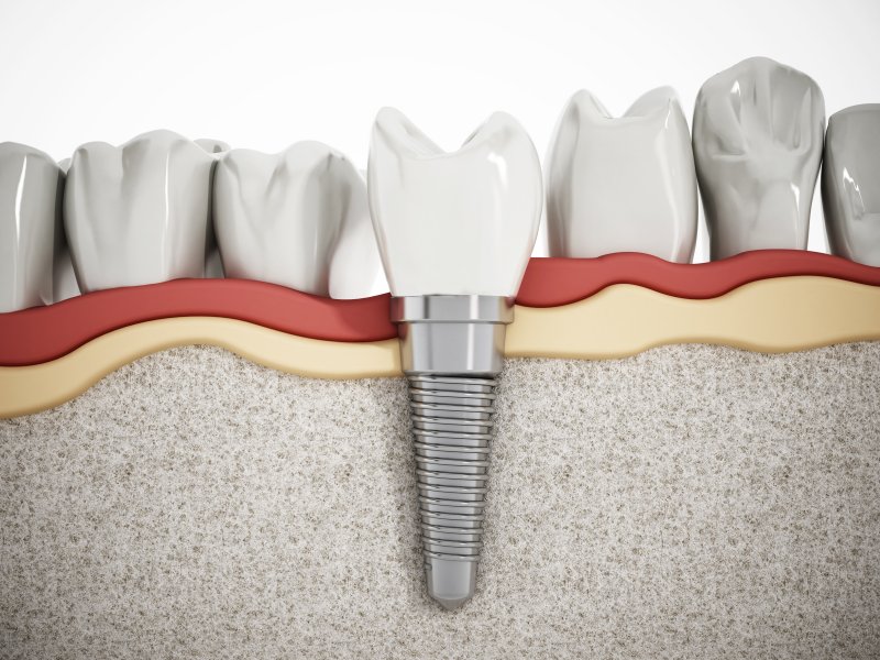 example of dental implant